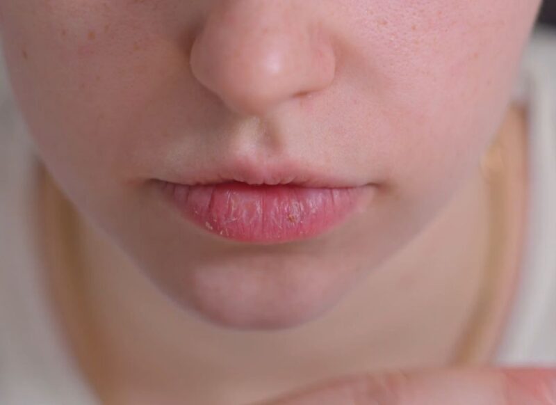 prikaz suvih usana i suve kože lica