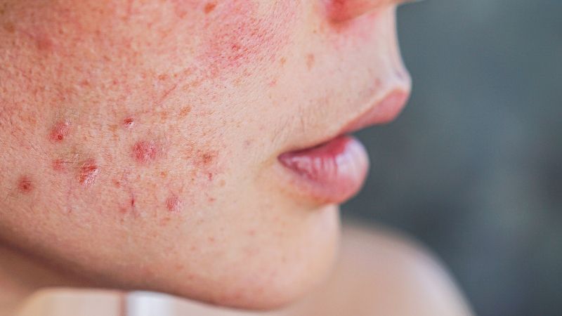 Krupan kadar obraza sa izraženim crvenilom, upaljenim bubuljicama i iritacijama na koži